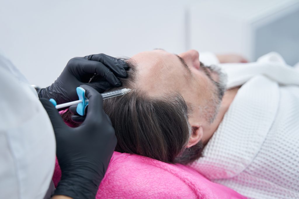 Cuánto dura un injerto capilar