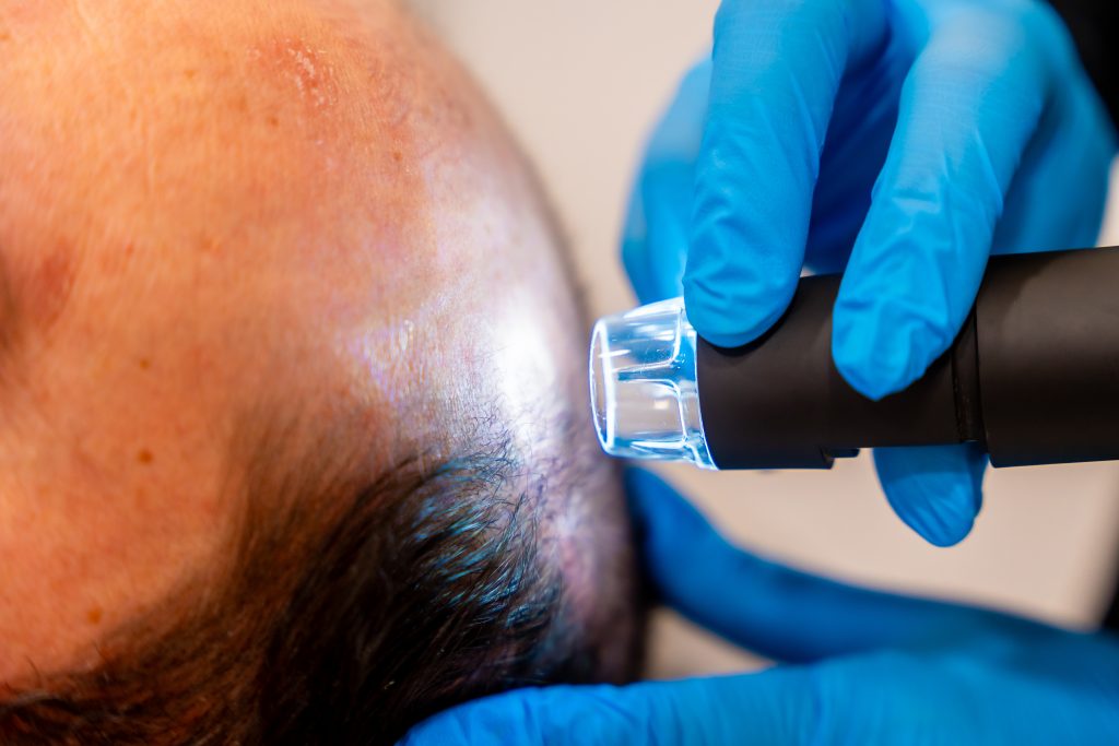 Cuánto cuesta un injerto capilar en España