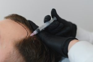 Injerto capilar mal hecho