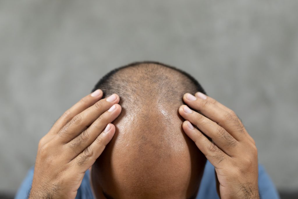 Se me cae el pelo injertado en los lavados