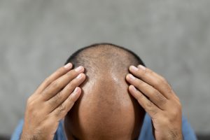 Se me cae el pelo injertado en los lavados