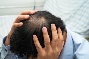 Señales de advertencia de la alopecia
